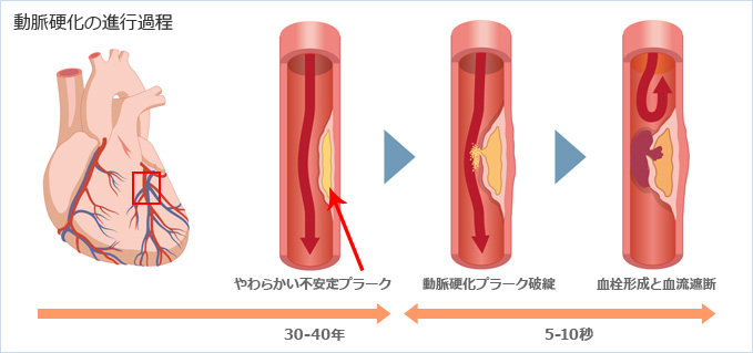 動脈硬化の進行過程
